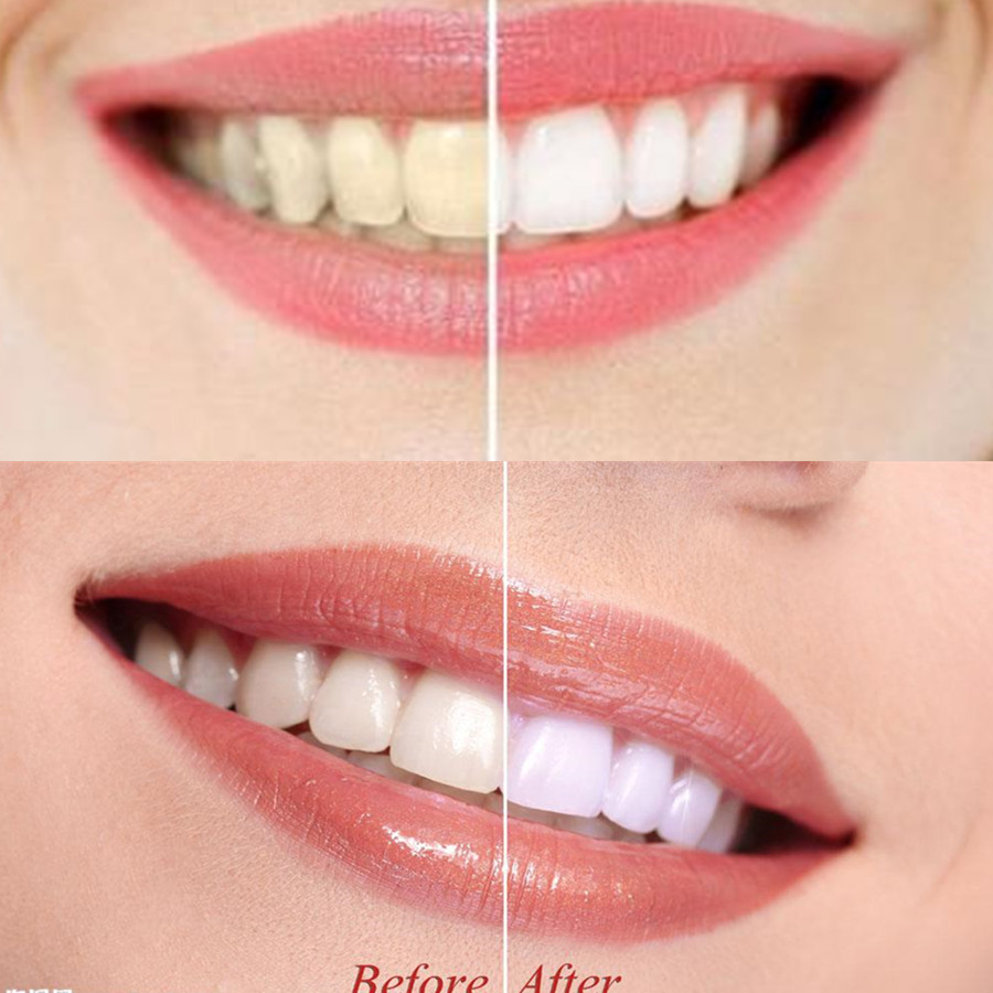 ถ่านไม้ไผ่ฟันฟันทันตกรรมสูตร L - Teeth Whitening Ingredients บทวิจารณ์และราคา