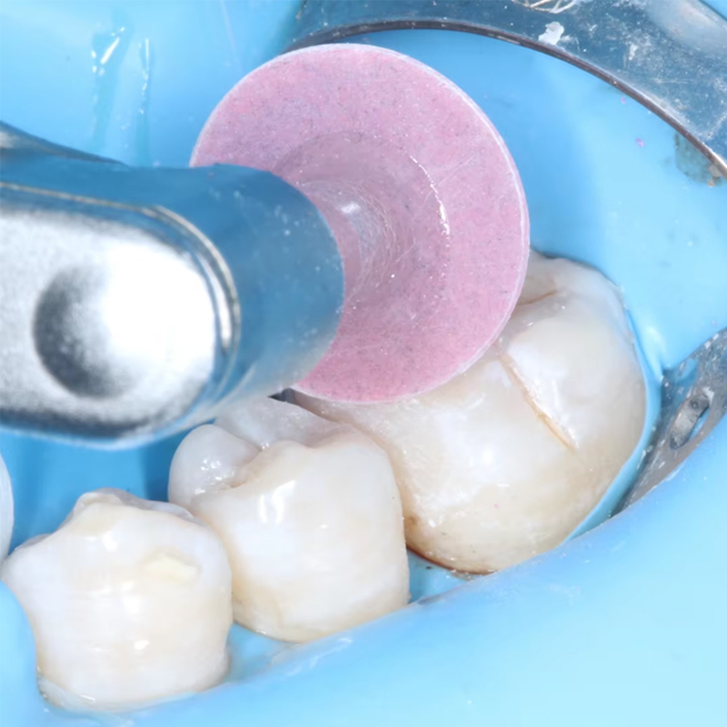 แผ่นขัดฟัน 40 ชิ้น สำหรับขัดเร - Whitening Teeth Dentist บทวิจารณ์และราคา