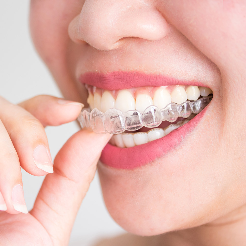 ชุดอุปกรณ์จัดฟันแบบใส 2/4 ชิ้น - Teeth Whitening For Trays บทวิจารณ์และราคา