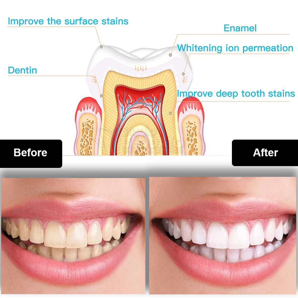 ทันตกรรมชุดฟอกสีฟัน Mini 16 LE - Teeth Whitening For Trays บทวิจารณ์และราคา